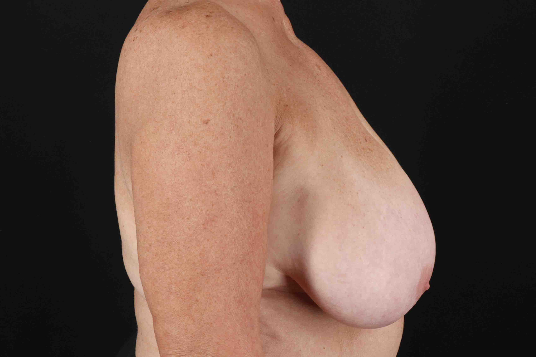 Breast Reduction with Lift Before & After Patient #1016