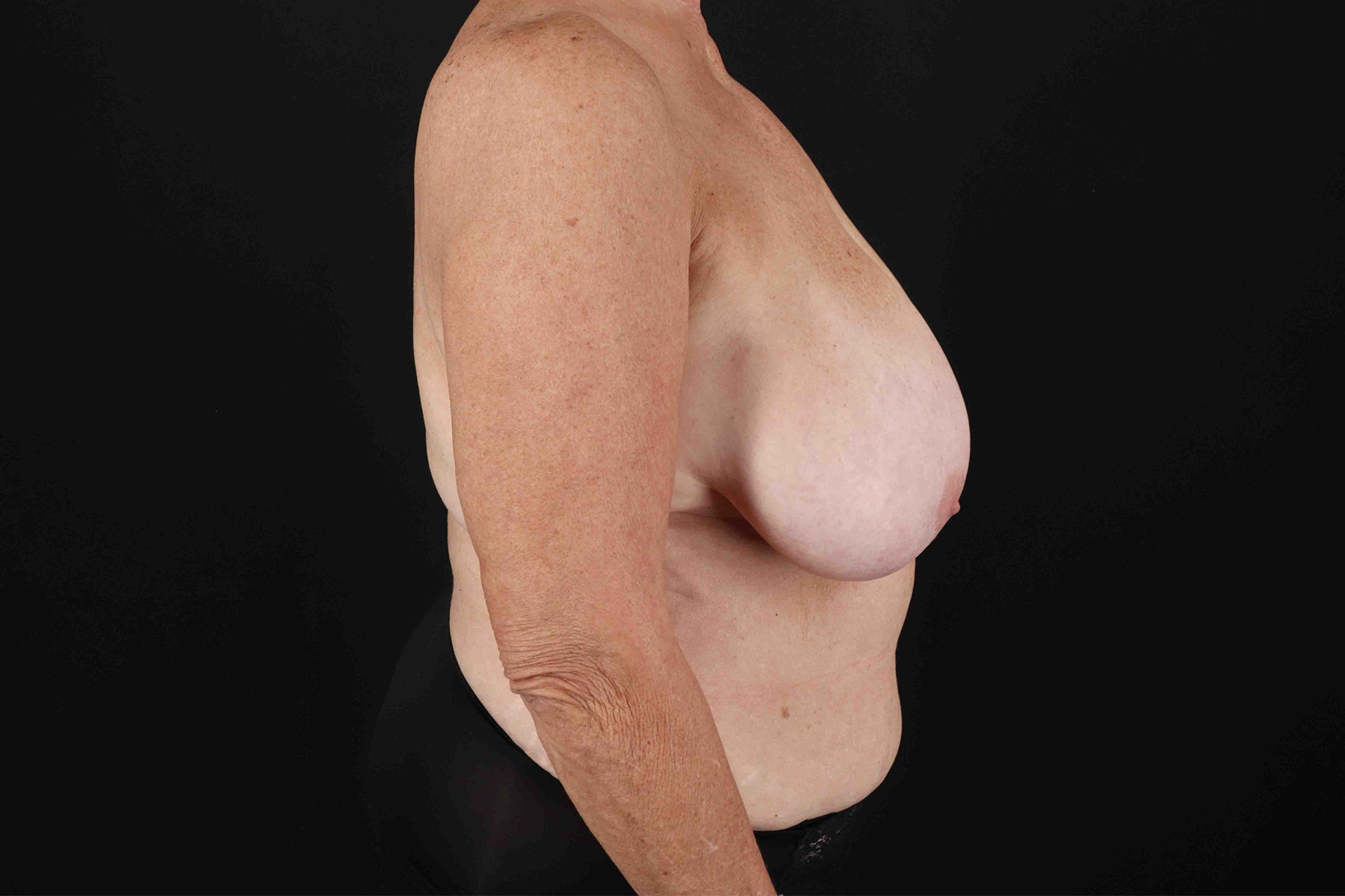 Mommy Makeover Before & After Patient #1353
