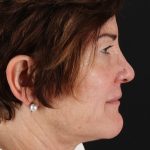 Helix CO2 Laser Before & After Patient #3855