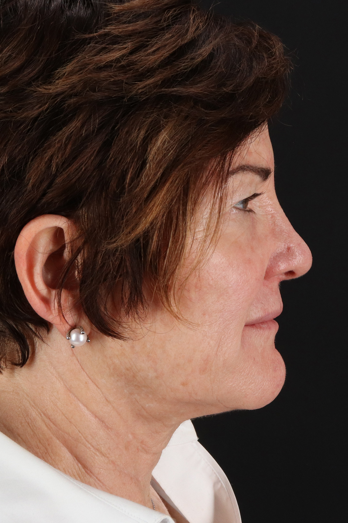 Helix CO2 Laser Before & After Patient #3855