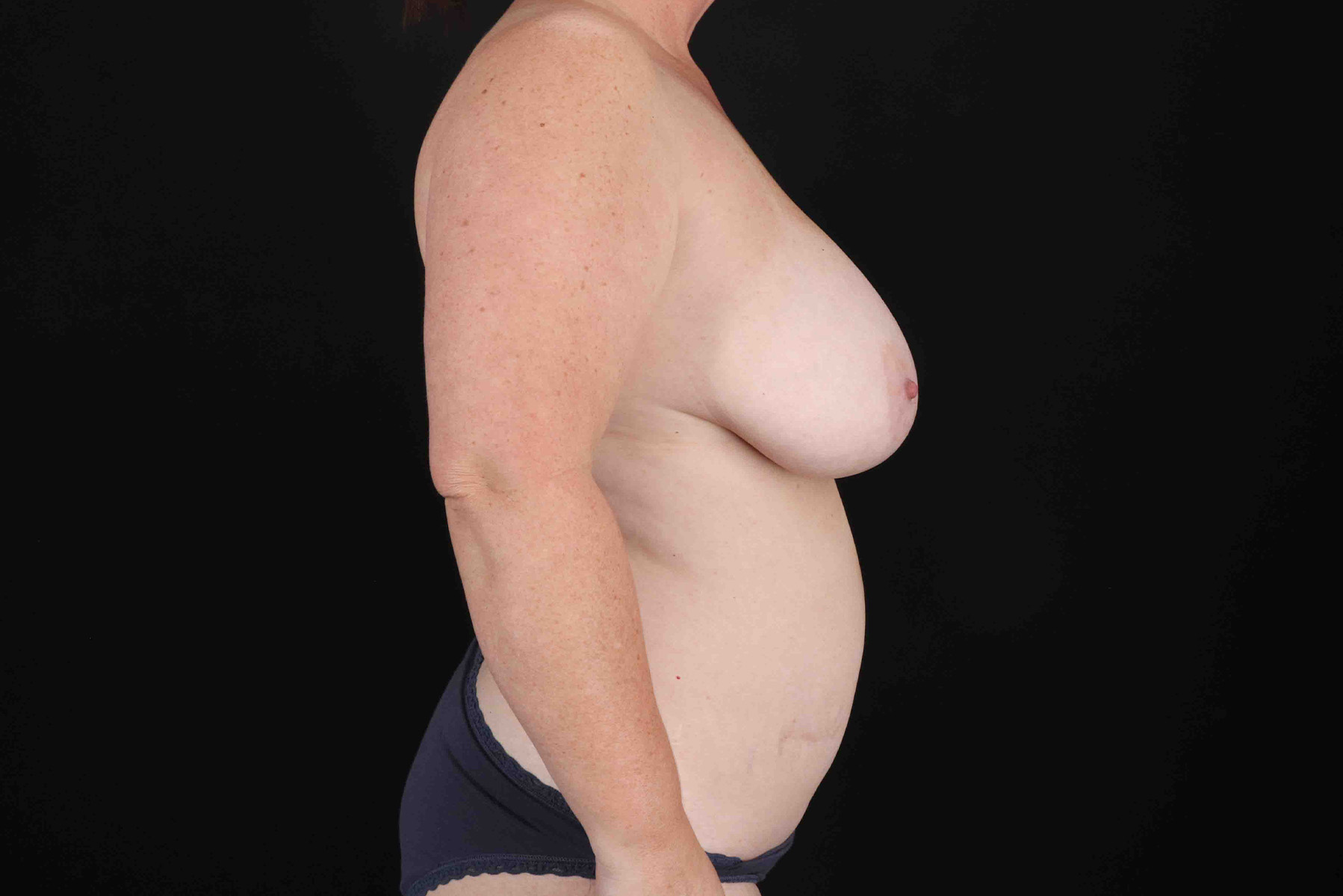 Mommy Makeover Before & After Patient #1342