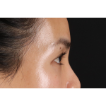 Eyelid Surgery Before & After Patient #1935