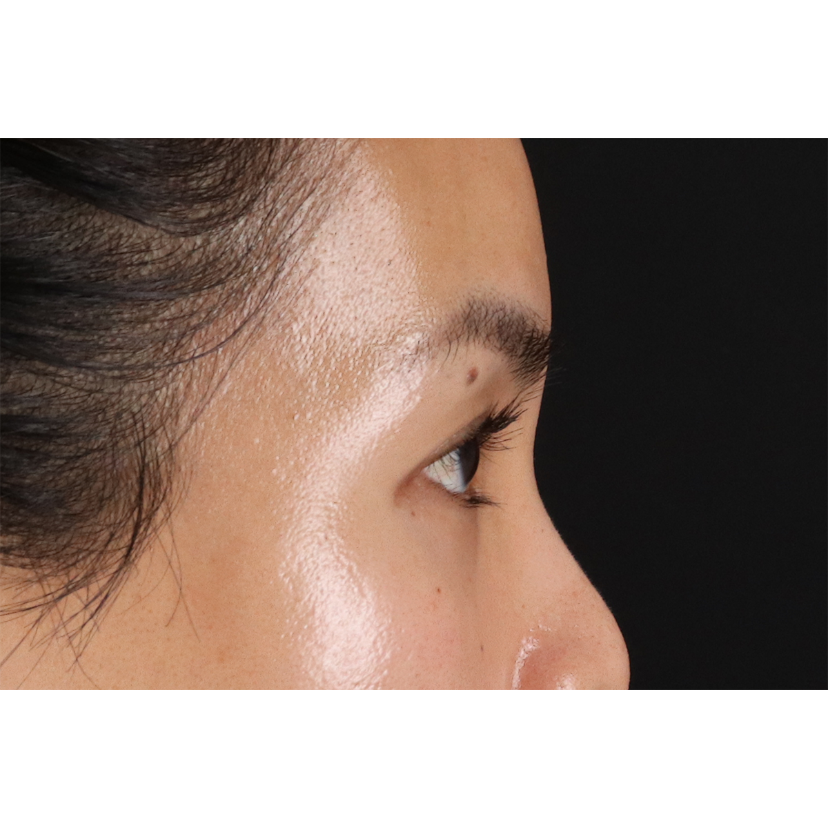 Eyelid Surgery Before & After Patient #1935
