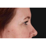 Brow Lift Before & After Patient #1566