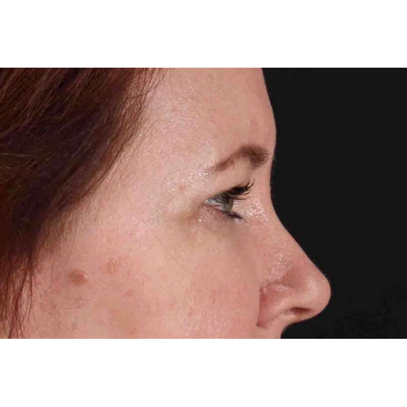 Brow Lift Before & After Patient #1566