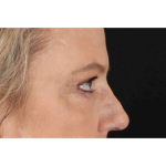 Brow Lift Before & After Patient #1577