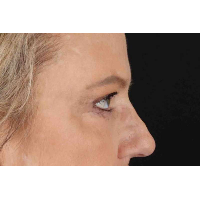 Brow Lift Before & After Patient #1577