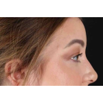 Brow Lift Before & After Patient #1588