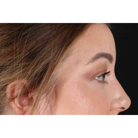 Brow Lift Before & After Patient #1588