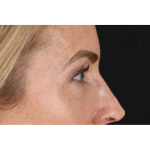 Laser Before & After Patient #2070