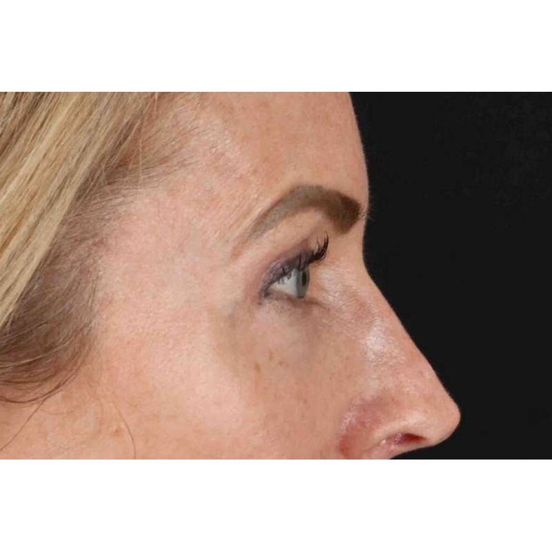 Laser Before & After Patient #2070