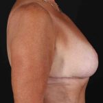 Breast Reduction with Lift Before & After Patient #1016