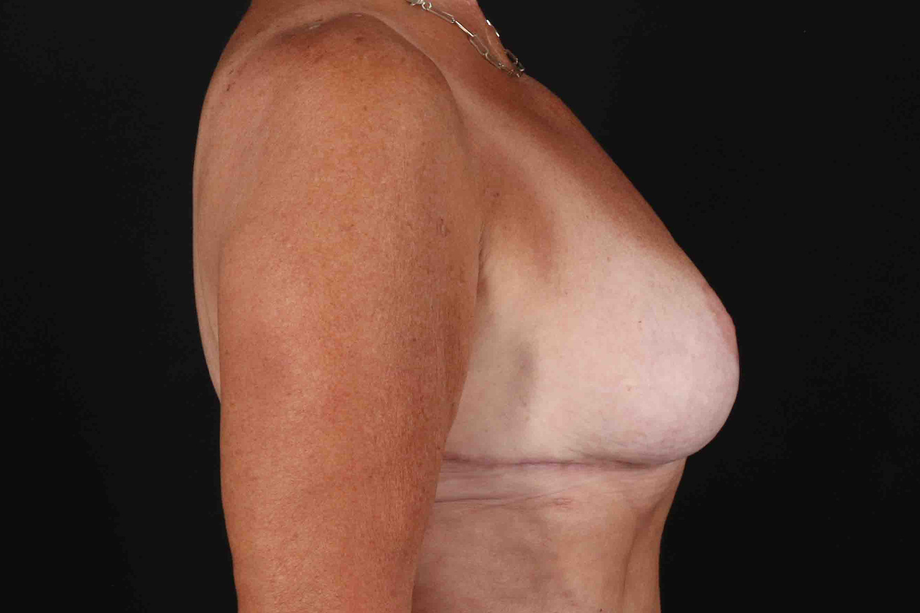 Breast Reduction with Lift Before & After Patient #1016
