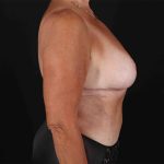Mommy Makeover Before & After Patient #1353