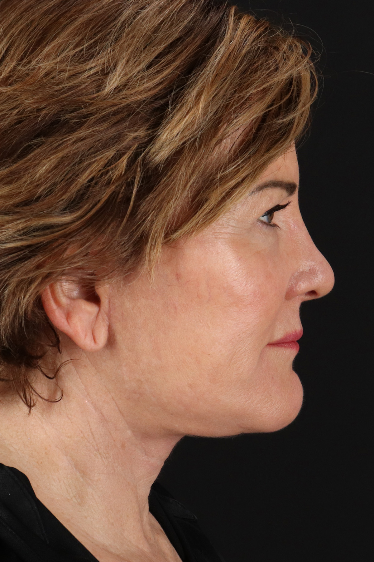 Helix CO2 Laser Before & After Patient #3855