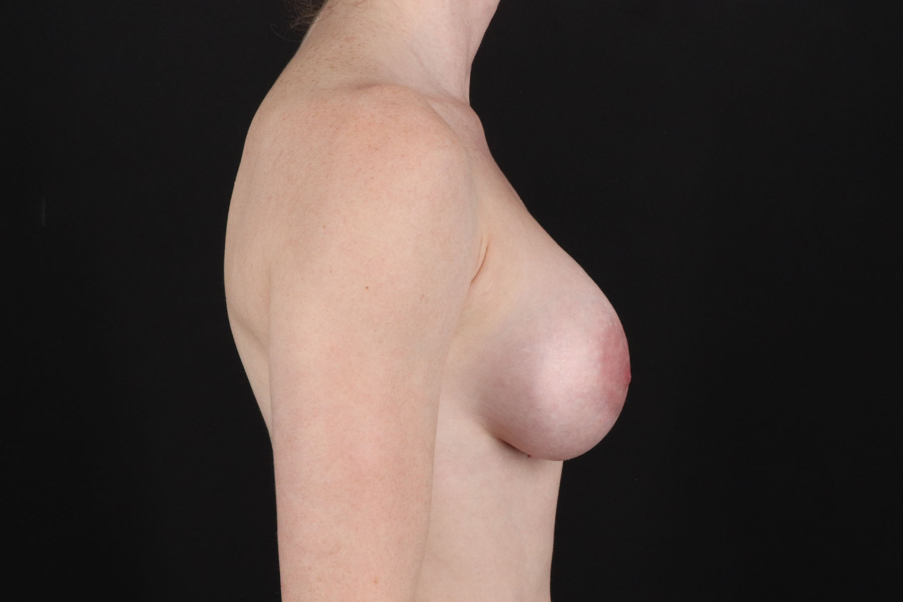 Breast Augmentation with Implants Before & After Patient #1247