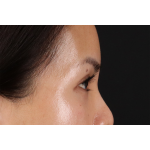 Eyelid Surgery Before & After Patient #1935