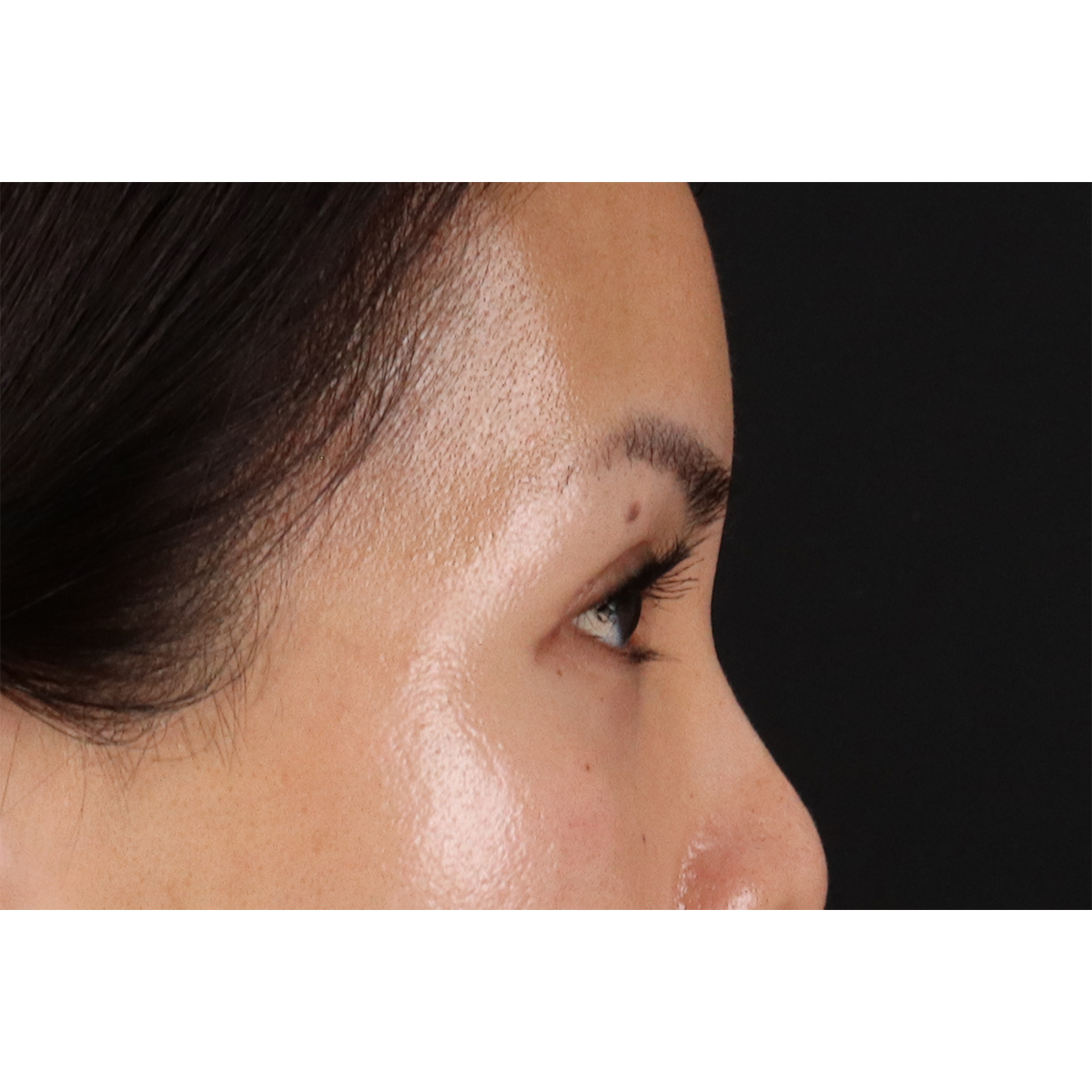 Eyelid Surgery Before & After Patient #1935