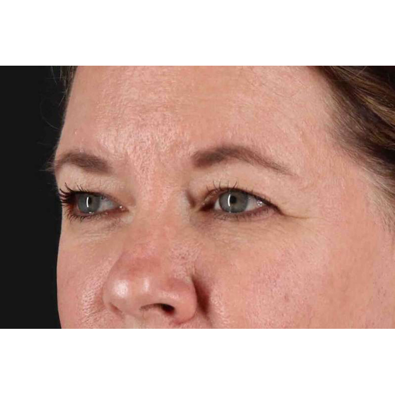 Brow Lift Before & After Patient #1566