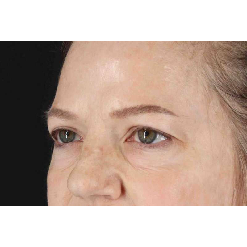 Brow Lift Before & After Patient #1577