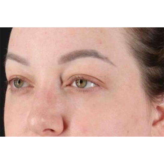 Brow Lift Before & After Patient #1588