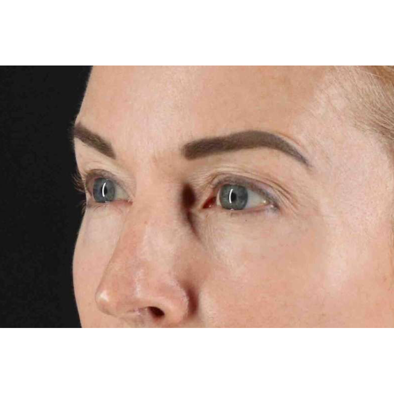 Laser Before & After Patient #2070