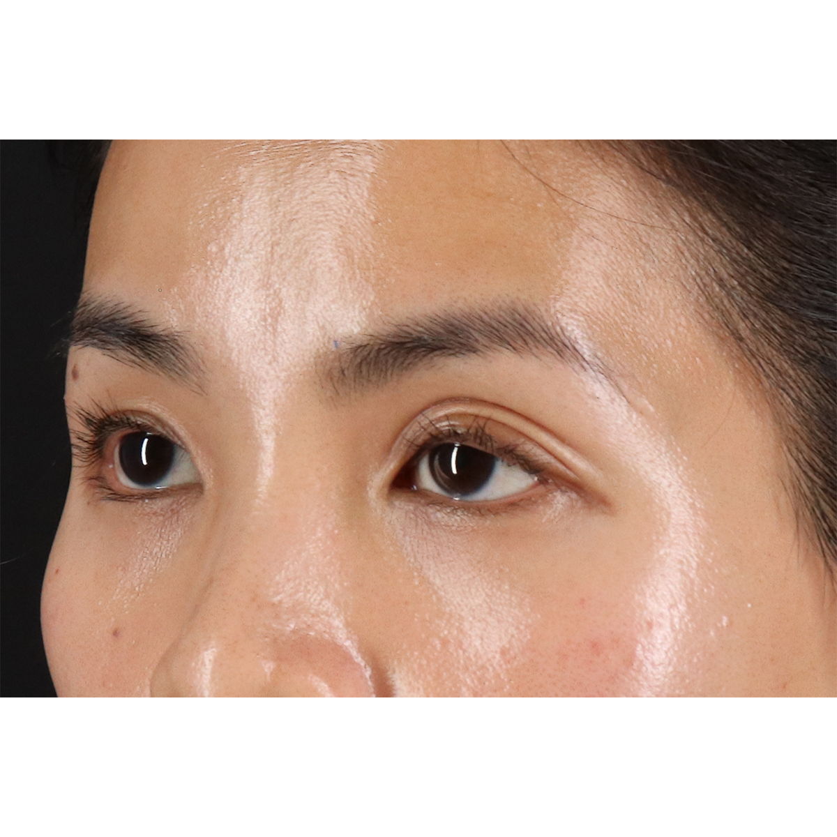 Eyelid Surgery Before & After Patient #1935