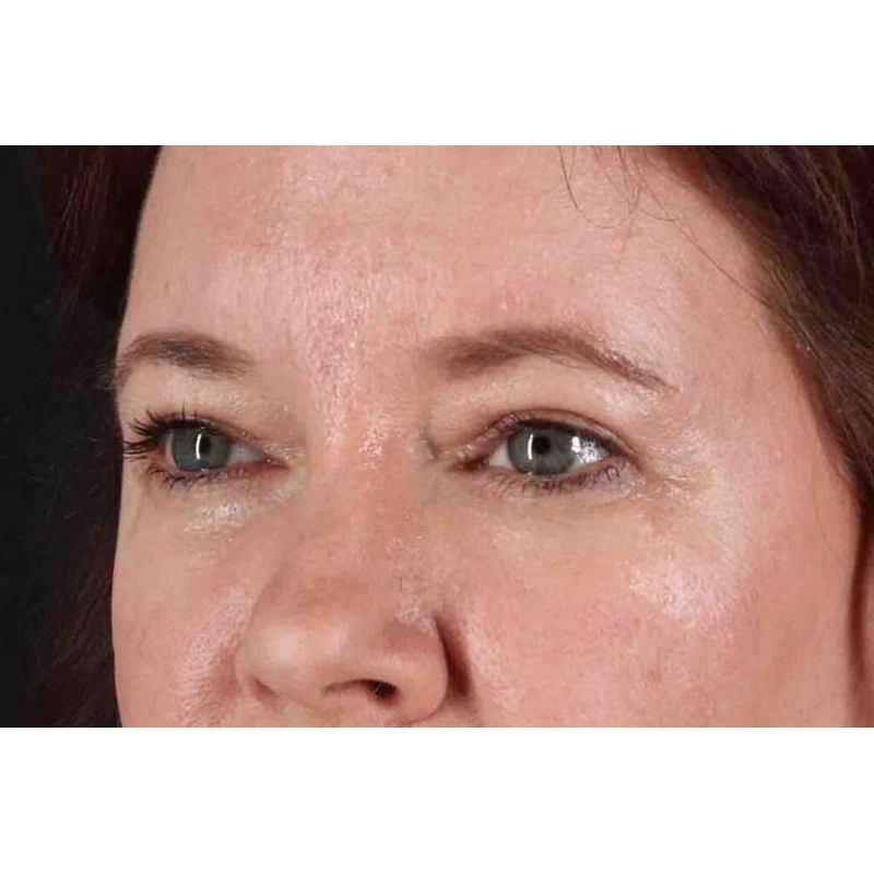 Brow Lift Before & After Patient #1566