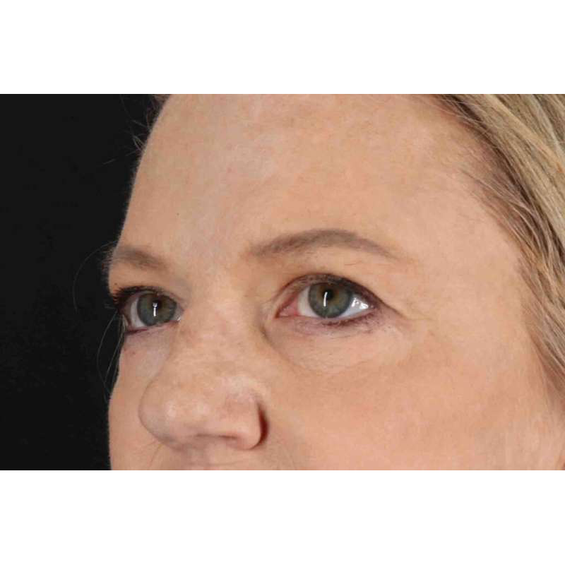 Brow Lift Before & After Patient #1577