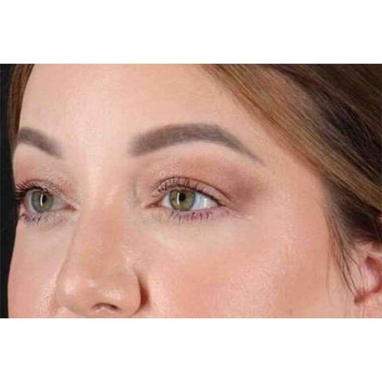 Brow Lift Before & After Patient #1588