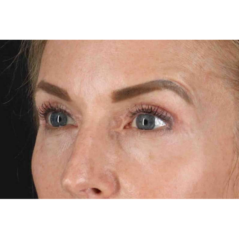 Laser Before & After Patient #2070