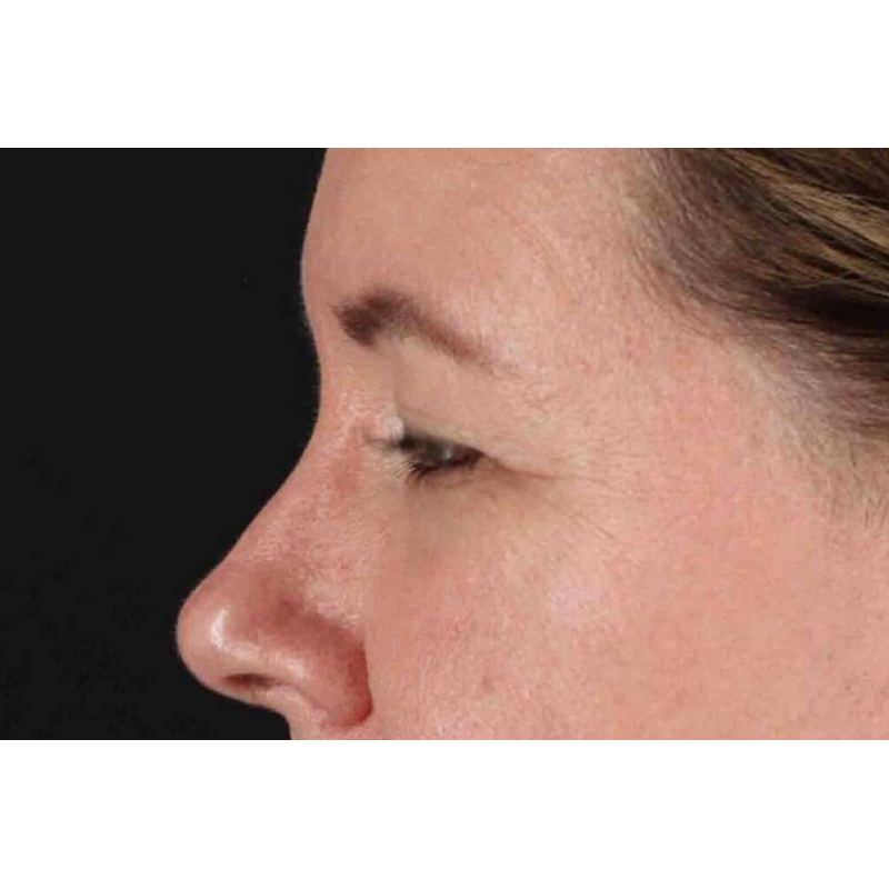 Brow Lift Before & After Patient #1566
