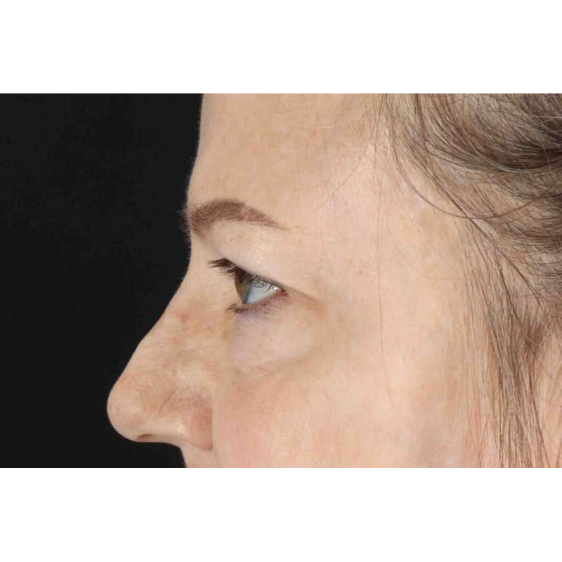 Brow Lift Before & After Patient #1577