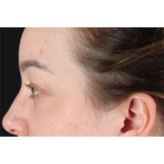 Brow Lift Before & After Patient #1588