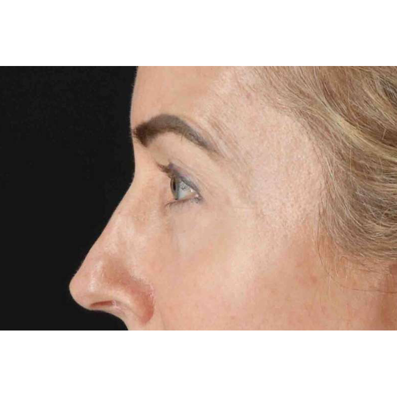 Laser Before & After Patient #2070