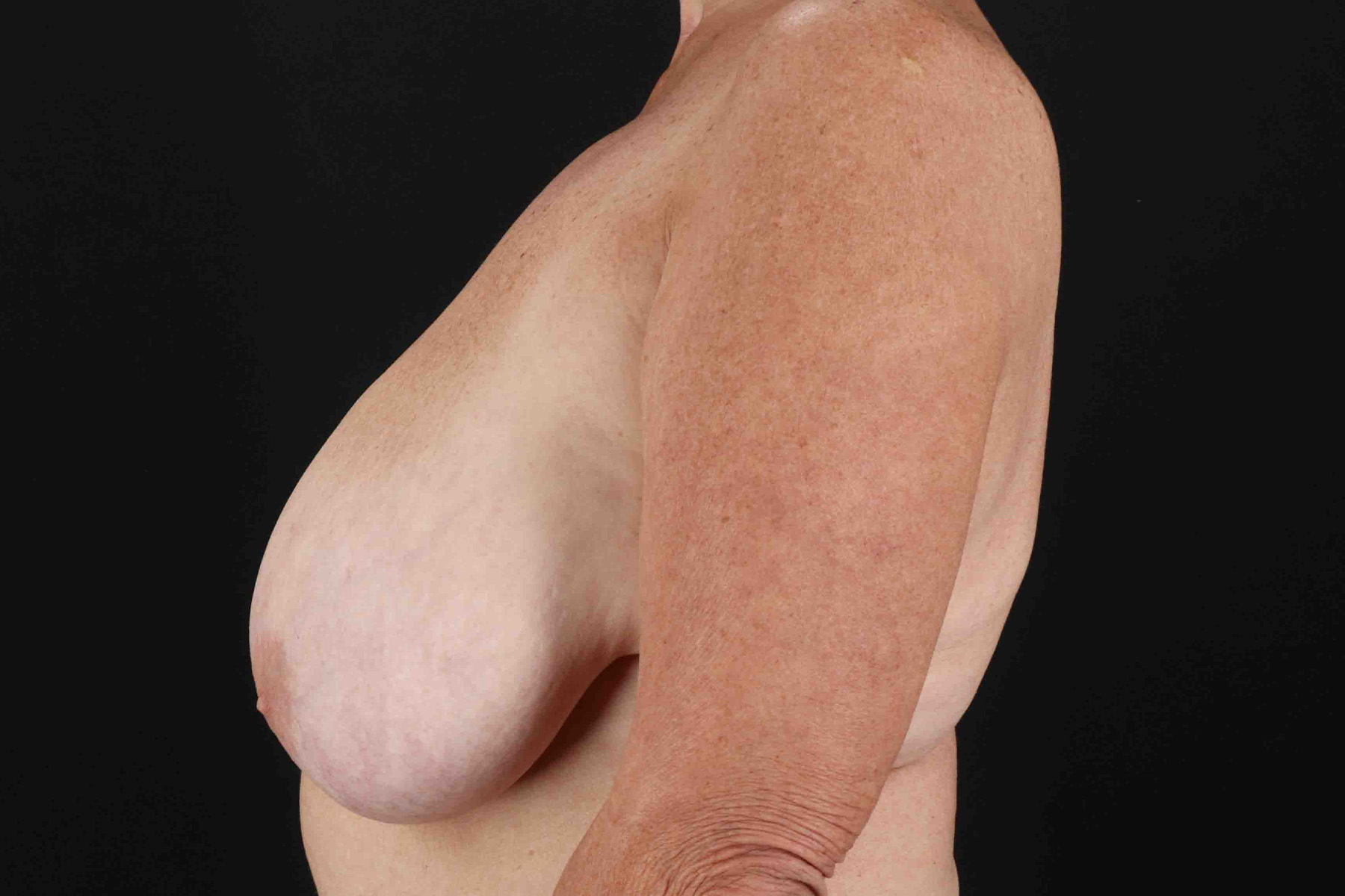Breast Reduction with Lift Before & After Patient #1016