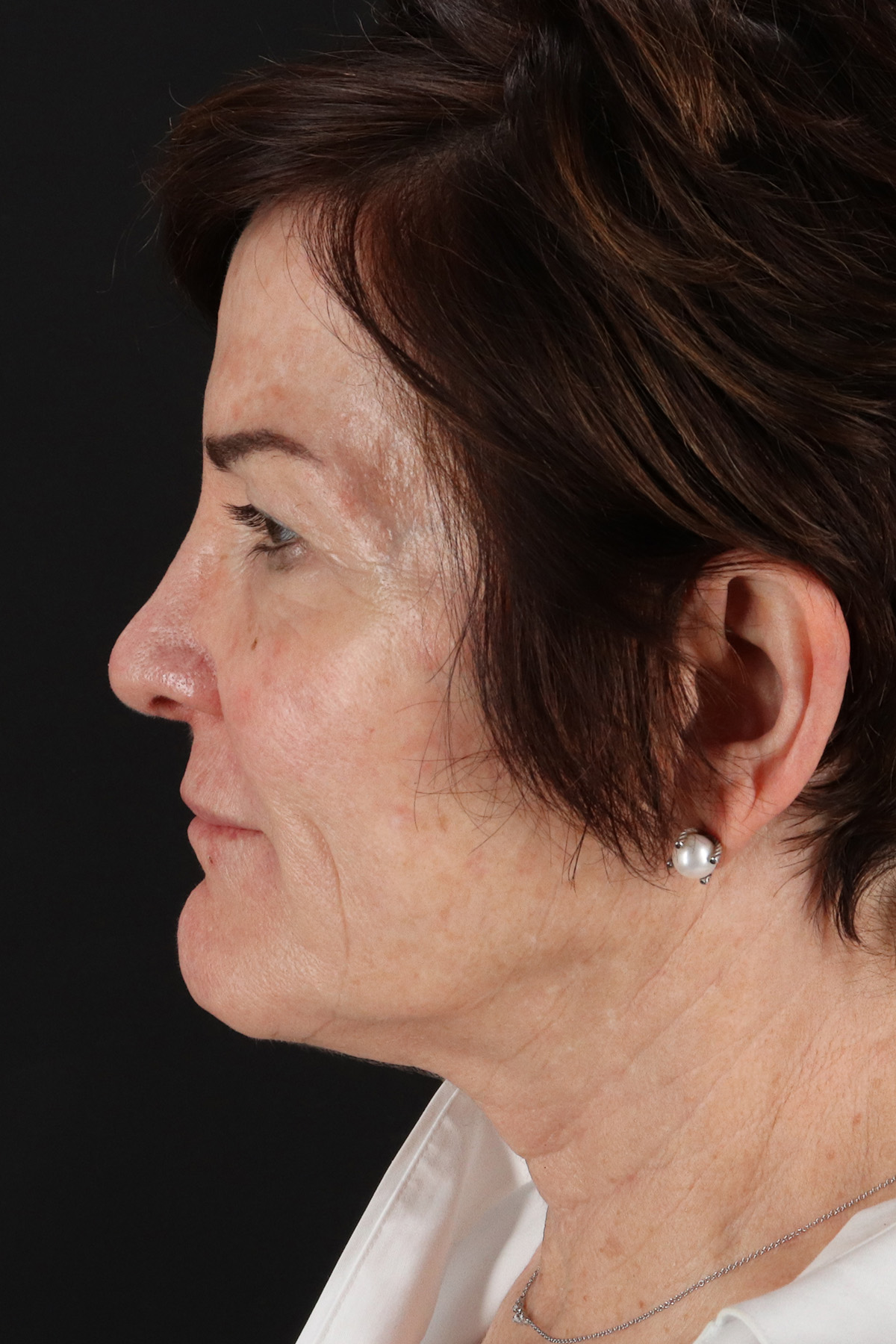 Helix CO2 Laser Before & After Patient #3855