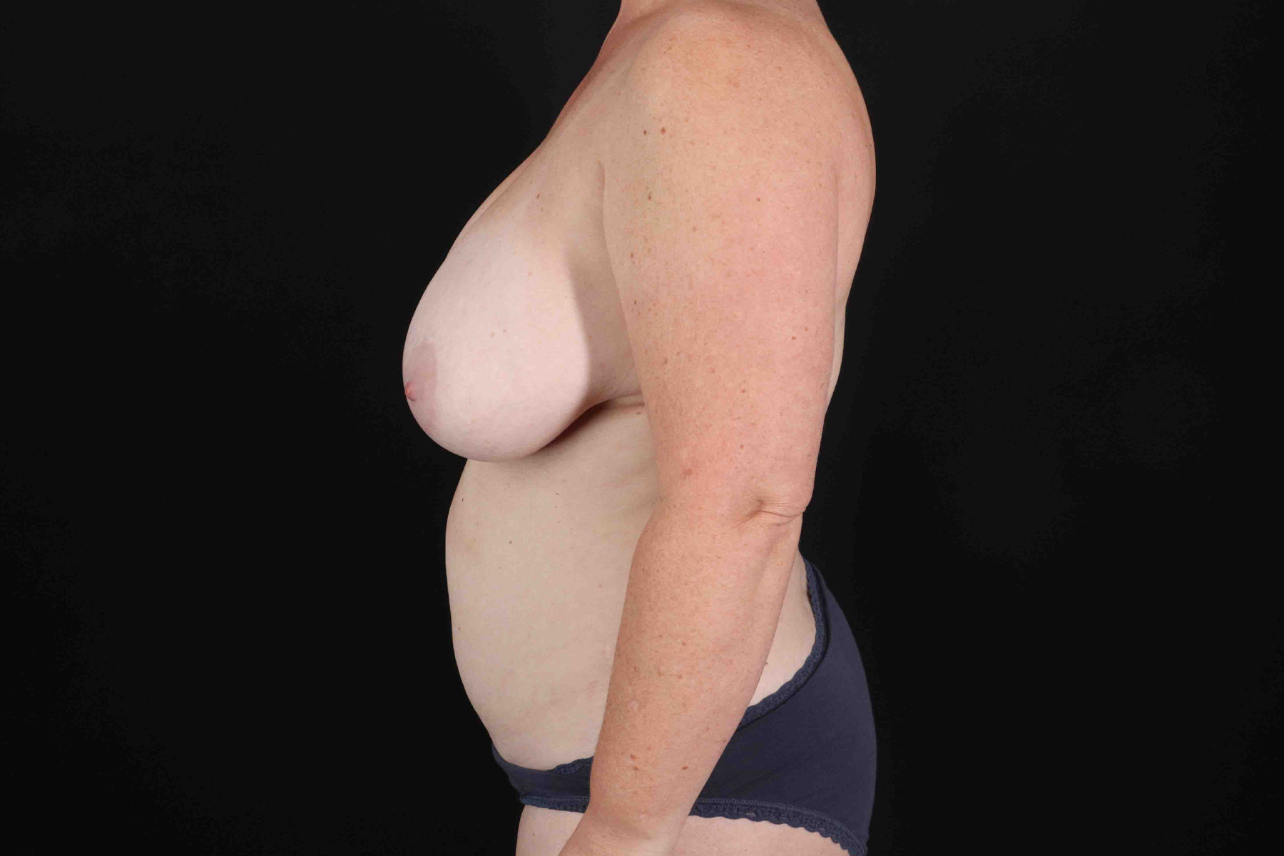 Mommy Makeover Before & After Patient #1342