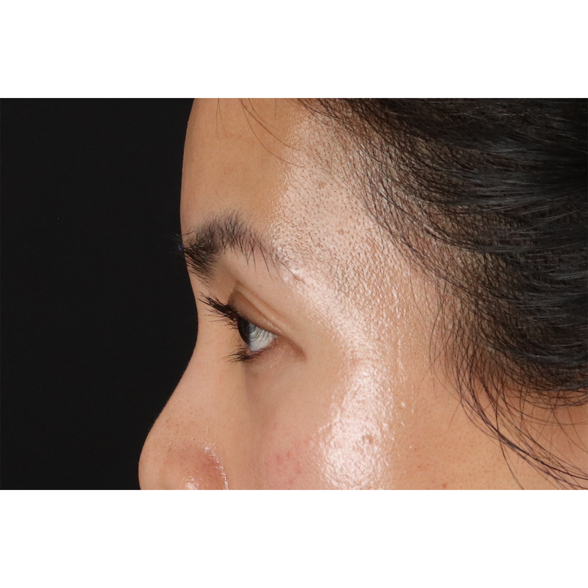 Eyelid Surgery Before & After Patient #1935