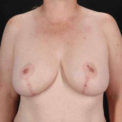 Breast Augmentation with Fat Transfer Before & After Patient #795