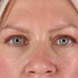 Eyelid Surgery Before & After Patient #1902