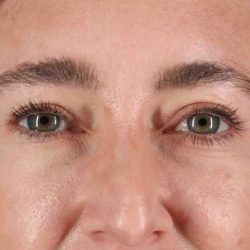 Eyelid Surgery Before & After Patient #1913