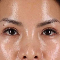 Eyelid Surgery Before & After Patient #1935