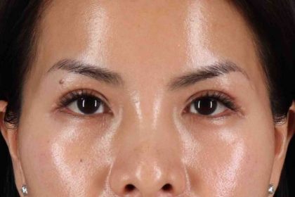Eyelid Surgery Before & After Patient #1935