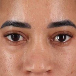 Eyelid Surgery Before & After Patient #1946