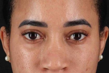 Eyelid Surgery Before & After Patient #1946
