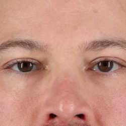 Eyelid Surgery Before & After Patient #1957