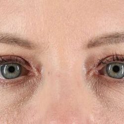 Eyelid Surgery Before & After Patient #1968