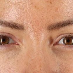 Eyelid Surgery Before & After Patient #1979