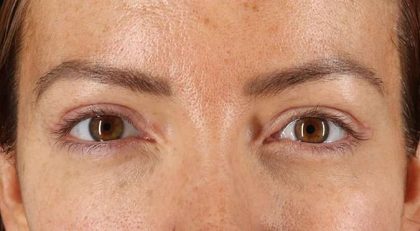 Eyelid Surgery Before & After Patient #1979